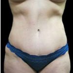 Liposuction and Mommy Makeover Before & After Patient #1150