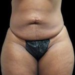 Liposuction and Mommy Makeover Before & After Patient #1157