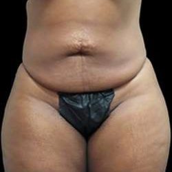 Liposuction and Mommy Makeover Before & After Patient #1157