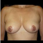 Liposuction and Breast Reduction Before & After Patient #683