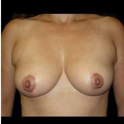 Liposuction and Breast Reduction Before & After Patient #683