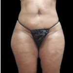 Liposuction and Mommy Makeover Before & After Patient #1177