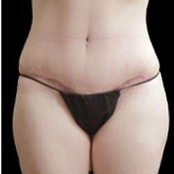 Liposuction and Mommy Makeover Before & After Patient #1186