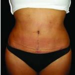 Liposuction and Mommy Makeover Before & After Patient #1193