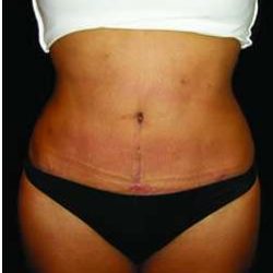 Liposuction and Mommy Makeover Before & After Patient #1193