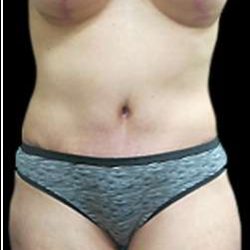 Liposuction and Mommy Makeover Before & After Patient #1218