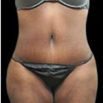 Liposuction and Mommy Makeover Before & After Patient #1231