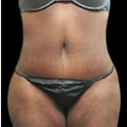 Liposuction and Mommy Makeover Before & After Patient #1231