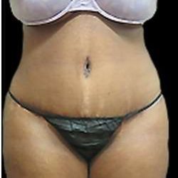 Liposuction and Mommy Makeover Before & After Patient #1240