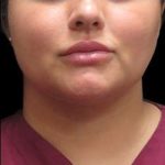 Laser Neck Lift and Submental Liposuction Before & After Patient #1258