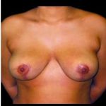 Liposuction and Breast Reduction Before & After Patient #694