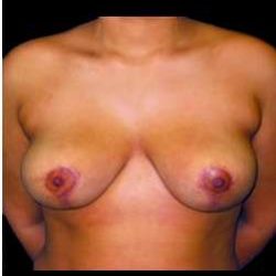 Liposuction and Breast Reduction Before & After Patient #694