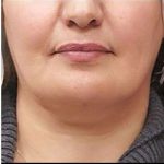 Laser Neck Lift and Submental Liposuction Before & After Patient #1279
