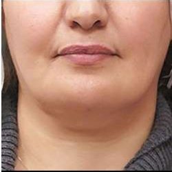 Laser Neck Lift and Submental Liposuction Before & After Patient #1279
