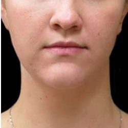 Laser Neck Lift and Submental Liposuction Before & After Patient #1286