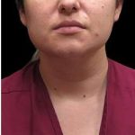Laser Neck Lift and Submental Liposuction Before & After Patient #1297