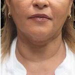 Laser Neck Lift and Submental Liposuction Before & After Patient #1315