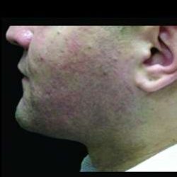 Laser Neck Lift and Submental Liposuction Before & After Patient #1318