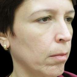 Laser Neck Lift and Submental Liposuction Before & After Patient #1321