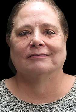 Laser Neck Lift and Submental Liposuction Before & After Patient #1328