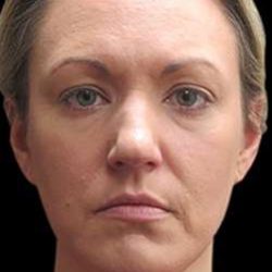 Laser Neck Lift and Submental Liposuction Before & After Patient #1335