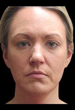 Laser Neck Lift and Submental Liposuction Before & After Patient #1335