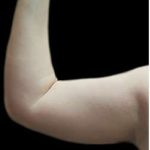 Arm Liposuction Before & After Patient #622
