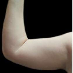 Arm Liposuction Before & After Patient #622