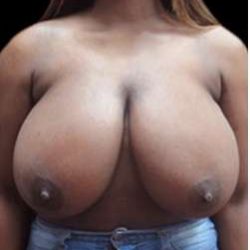 Liposuction and Breast Reduction Before & After Patient #705