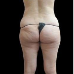 Super Wet Liposuction Before & After Patient #1358
