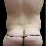 Super Wet Liposuction Before & After Patient #1367