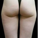 Super Wet Liposuction Before & After Patient #1372