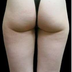 Super Wet Liposuction Before & After Patient #1372