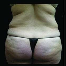 Super Wet Liposuction Before & After Patient #1381