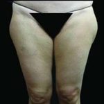 Super Wet Liposuction Before & After Patient #1386