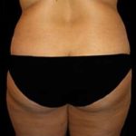 Super Wet Liposuction Before & After Patient #1389