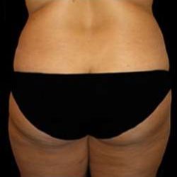 Super Wet Liposuction Before & After Patient #1389