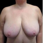Liposuction and Breast Reduction Before & After Patient #712