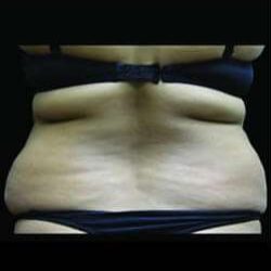 Super Wet Liposuction Before & After Patient #1399