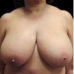 Liposuction and Breast Reduction Before & After Patient #719