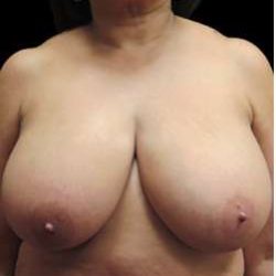 Liposuction and Breast Reduction Before & After Patient #719