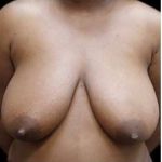 Liposuction and Breast Reduction Before & After Patient #726