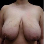 Liposuction and Breast Reduction Before & After Patient #740