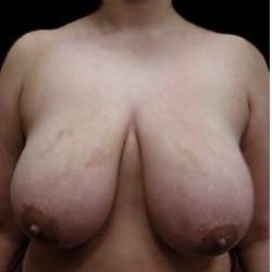 Liposuction and Breast Reduction Before & After Patient #740
