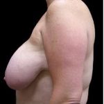 Liposuction and Breast Reduction Before & After Patient #743