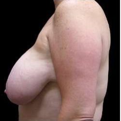 Liposuction and Breast Reduction Before & After Patient #743