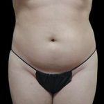 Laser Liposuction and Cellulaze Before & After Patient #759
