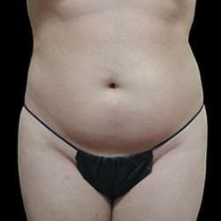 Laser Liposuction and Cellulaze Before & After Patient #759