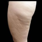 Laser Liposuction and Cellulaze Before & After Patient #762