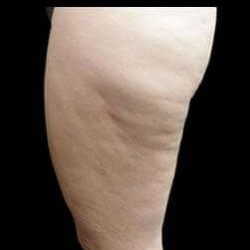 Laser Liposuction and Cellulaze Before & After Patient #762